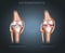 Osteoarthritis and normal joint anatomy