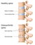 Osteoarthritis of the spine