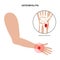 Osteomyelitis of arm