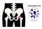 Osteomyelitis of hip