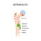 Osteomyelitis is infection in the bone