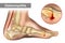 Osteomyelitis is an infection of bone. Diagram shows osteomyelitis of a humans foot bone.