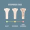 Osteoporosis bone density loss disease medical infographics