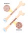 Osteoporosis. disease of bones