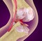 Osteoporosis of the knee joint