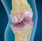 Osteoporosis of the knee joint