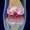 Osteoporosis of the knee joint,  Medically accurate