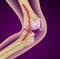 Osteoporosis of the knee joint, Medically accurate