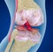 Osteoporosis of the knee joint,  Medically accurate illustration