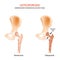 Osteoporosis. normal hip joint and bone with low bone mass