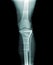 Osteosynthesis of a broken leg