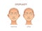 Otoplasty. Ear surgery. Vector illustration of female face before and after. Plastic surgery