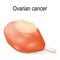 Ovarian cancer