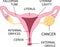 Ovarian Cancer. Ovarian carcinoma, germ cell tumor, sex cord stromal tumor