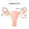 Ovarian cyst. A fluid-filled sac in the ovary.