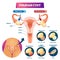 Ovarian cyst vector illustration. Labeled medical condition types scheme.