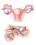 Ovaries - Cystectomy