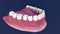 Overdenture to be seated on 4 implants - ball attachments