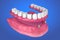 Overdenture to be seated on ball attachments