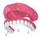 Overdenture to be seated on implants attachments