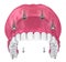 Overdenture to be seated on implants attachments