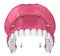 Overdenture to be seated on implants attachments.