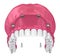 Overdenture to be seated on implants attachments