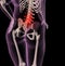 Overweight female skeleton with back pain