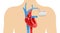 Pacemaker anatomical scheme