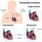 Pacemaker insertion surgery