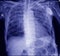 Pacemaker in x-ray image in cardiac catheterization laboratory