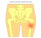 Pain in the hip joint_subtrochanteric femur fracture