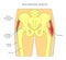 Pain in the hip joint_trochanteric bursitis