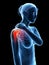 Pain in the shoulder joint