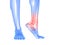 Painful ankle illustration
