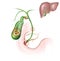Painful gallstones in gallbladder, anatomical illustration
