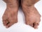 Painful gout inflammation of foot