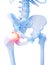 Painful hip joint
