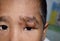 Painful, large abscess or Staphylococcal / Streptococcal skin infection or carbuncles in face of Southeast Asian Burmese child.