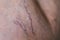 Painful varicose and spider veins