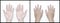 Pale palmar and dorsal surface of both hands. Anaemic hands of Asian, Chinese man