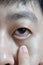 Pale skin of Asian man. Sign of anemia. Pallor at eyelid