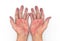 Palmar erythema often called liver palms in both hands of Southeast Asian, Myanmar man