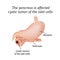 The pancreas is affected cystic tumor of the
