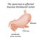 The pancreas is affected mucous intraductal tumor