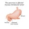 The pancreas is affected mucous intraductal tumor