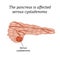 The pancreas is affected serous cystadenoma