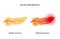 Pancreas disease and cancer