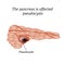 Pancreas pseudocyst affected. Vector illustration