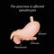 Pancreas pseudocyst affected. Vector illustration on a black background